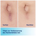BEPANCARE Narben-Gel